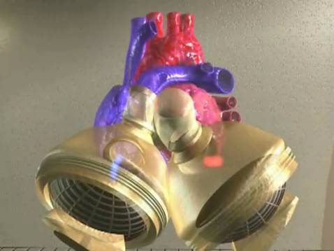 Un cuore artificiale totale per una paziente di 39 anni, a Siena intervento unico in Toscana