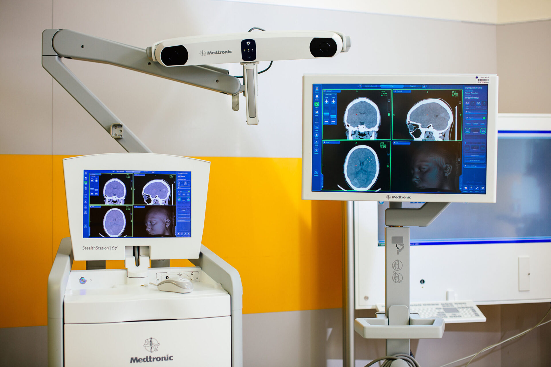 Tecnologia in neurochirurgia.  Un robot in sala operatoria, al Meyer operata paziente con grave epilessia