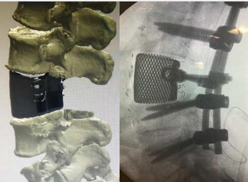 Il futuro della medicina. Vertebra stampata in 3D impiantata in 56enne affetto da tumore osseo