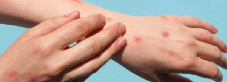 Al via la vaccinazione contro il vaiolo delle scimmie: si parte il 29 agosto per i soggetti ad alto rischio
